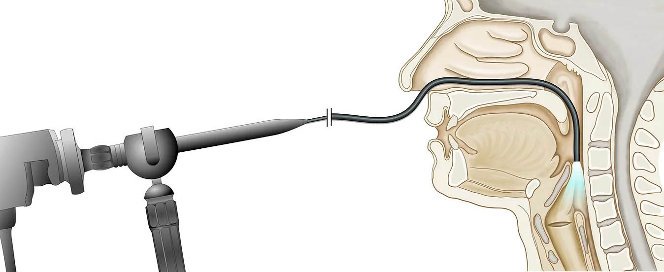 Fiberoptic endoscopic illustration - Speech therapy